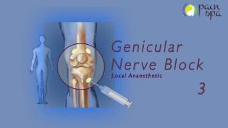 Coolief Genicular nerve block by Dr Murli Krishna Pain Specialist Bristol [upl. by Bay]