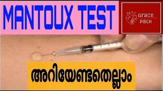 Mantoux Test  Tuberculin Skin Test TST Malayalam [upl. by Blatman710]