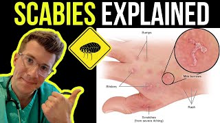 Doctor explains SCABIES skin rash including SYMPTOMS PHOTOS OF SKIN TREATMENT amp more [upl. by Hamaso]