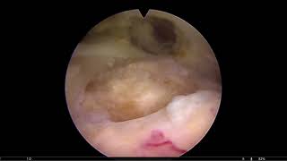 Schulterarthroskopie mit einfacher Rotatorenmanschettennaht [upl. by Misha]