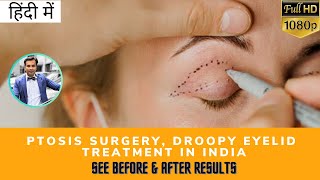 हिंदी में Ptosis Surgery Droopy Eyelid Treatment in India  Before amp After Results TEC [upl. by Idet]