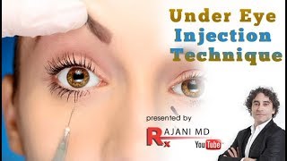 Under Eye Injection Technique [upl. by Cordelia]