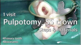 1 visit pulpotomy SS crown steps amp materials [upl. by Edahs]