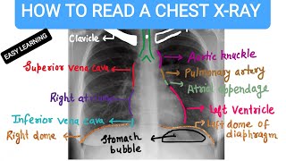 How To Read A Chest Xray [upl. by Velda]