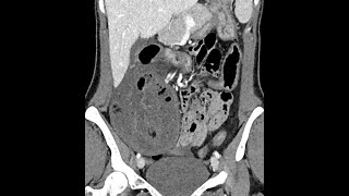 Small bowel ischemia associated with a parastomal hernia postileostomy in a Crohns disease patient [upl. by Rebma]