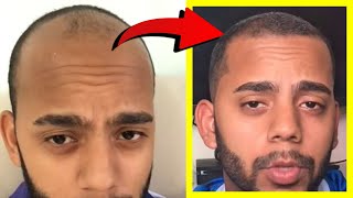 Crazy Minoxidil 5 Hair Growth in 25 Months Fails after 25 YEARS Heres WHY [upl. by Aleciram]