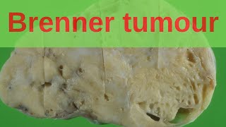 Brenner Tumour of the Ovary  Pathology mini tutorial [upl. by Dalila334]