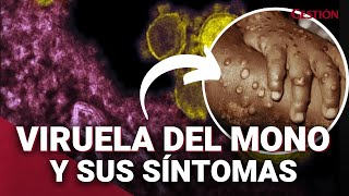 VIRUELA DEL MONO Qué es SÍNTOMAS y cómo se contagia esta enfermedad que alerta a la OMS [upl. by Elleimac402]