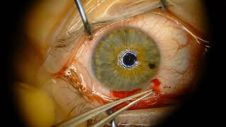 Astigmatic Keratotomy Long Scleral tunnel for astigmatism reduction [upl. by Aneloaup]