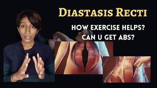 Can Diastasis Recti be corrected by exercise [upl. by Nnywg]