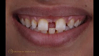 Combined approach for large diastema closure part II [upl. by Eizzik]