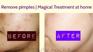 In 5 DAYS  Remove PIMPLE BLACK SPOTS amp ACNE SCARS  Remove pimples  Pimple Marksacne Fast [upl. by Ayahs]