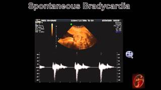 Fetal Echocardiograph Common Fetal Arrhythmias [upl. by Innis]