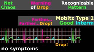 ECG Tutorial AV block EKG Mobitz electrocardiogram interpretation [upl. by Nabru]