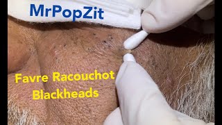 FavreRacouchot syndrome Multiple blackheads and whiteheads clustered together Face Extractions [upl. by Leihcim41]