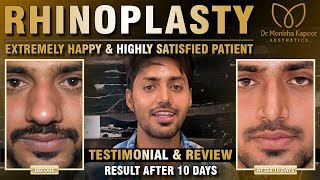 Rhinoplasty in Delhi  Extremely Happy amp Highly Satisfied Patient  Testimonial amp Review [upl. by Niwroc]