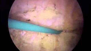 Arthroscopic Lateral Release and Medial Imbrication  ORV  Michael Magoline MD [upl. by Yrrac]