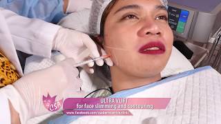 Ultra V Lift for face slimming and face contouring [upl. by Jemy]