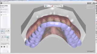 3Shape Dental System™ 2014  Splint Designer™ [upl. by Wehhtam672]