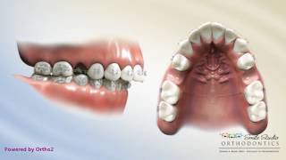 Upper 2nd Bicuspid Extraction  Overjet  Orthodontic Treatment [upl. by Fruin]