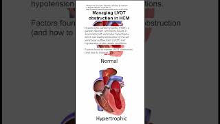 Managing left ventricular outflow tract LVOT obstruction in hypertrophic cardiomyopathy HCM [upl. by Flanders]