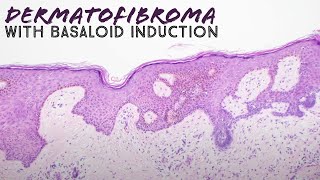 Dermatofibroma with basaloid follicular induction pathology mimic of basal cell carcinoma dermpath [upl. by Nalek217]