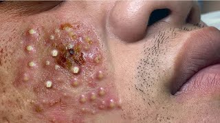 Big Cystic Acne Blackheads Extraction Blackheads amp Milia Whiteheads Removal Pimple Popping  3734 [upl. by Kcirdor]