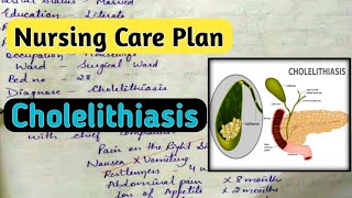 Nursing Care Plan on Cholelithiasis nursingcriteria [upl. by Button67]