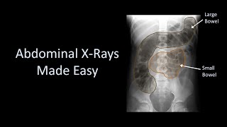 Abdominal XRays Made Easy [upl. by Notsnorb]