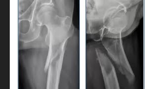 Nailing in Subtrochanteric Fractures [upl. by Ecined]