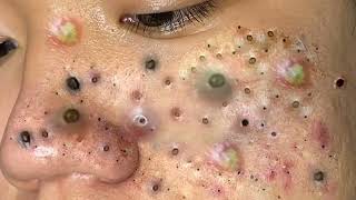 Big Cystic Acne Blackheads Extraction Blackheads amp Milia Whiteheads Removal Pimple Popping 0166 [upl. by Erodisi]