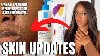 SKIN UPDATES Perioral Dermatitis amp Laser Hair Removal Dark Skin [upl. by Atsyrk449]