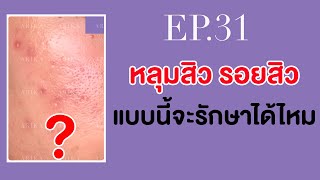 Ep31 หลุมสิว รอยสิว แบบนี้จะรักษาได้ไหม ลูกค้าลาว รักษาหลุมสิว skincare รีวิว microneedling [upl. by Shyamal]