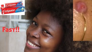 How To Get Rid of Piercing KeloidBump Antoinette Nunu George [upl. by Now957]