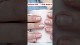 White Spots on Nails Causes and Solutions [upl. by Eilsew]