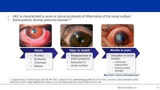 Understanding Vernal Keratoconjunctivitis VKC Not “Just an Allergy” [upl. by Ajdan]