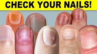 9 Things Your Nails Can Tell You About Your Health [upl. by Nonnarb]