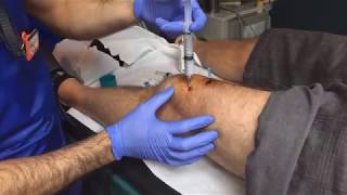 LIVE Precision Pain Medicine Ribi Demonstrates a Knee Genicular Block [upl. by Sada994]