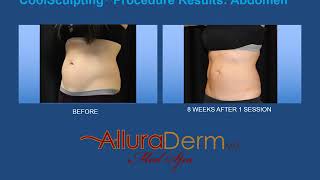 AlluraDerm CoolSculpting Before and After [upl. by Zak577]