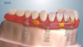 Etgar Implant Systems  Bar Dolder 00409 [upl. by Fisher915]