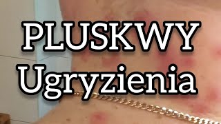 Jak wyglądają ugryzienia pluskiew pluskwy zwalczaniepluskiew lukaszbula [upl. by Pozzy]