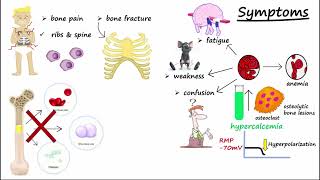 Multiple Myeloma [upl. by Shifrah]