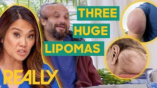 The Largest Lipoma Removals of Season 5  Dr Pimple Popper [upl. by Darcy387]