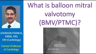 What is balloon mitral valvotomy BMVPTMC [upl. by Oirotciv552]