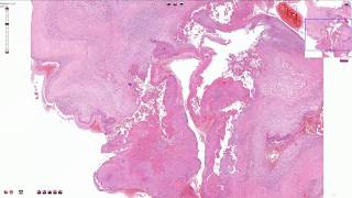 Infective Endocarditis  Histopathology [upl. by Sadiras]