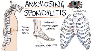 Ankylosing Spondylitis Visual Explanation for Students [upl. by Lladnar]