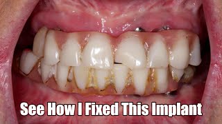 See How I Fixed This FullMouth Implant [upl. by Merkle898]