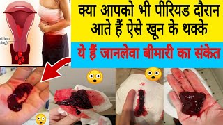 पीरियड में खून के थक्के आना क्या नार्मल हैl Blood Clots in Period  Period Blood में Clots 😲 [upl. by Norym]