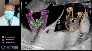 ULTRASSONOGRAFIA Gestação gemelar de 14 semanas [upl. by Whittaker781]