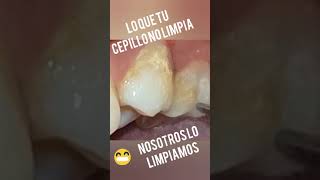 PROFILAXIS DENTAL cada 6 meses para mantener una buena Salud Bucal [upl. by Stephine639]